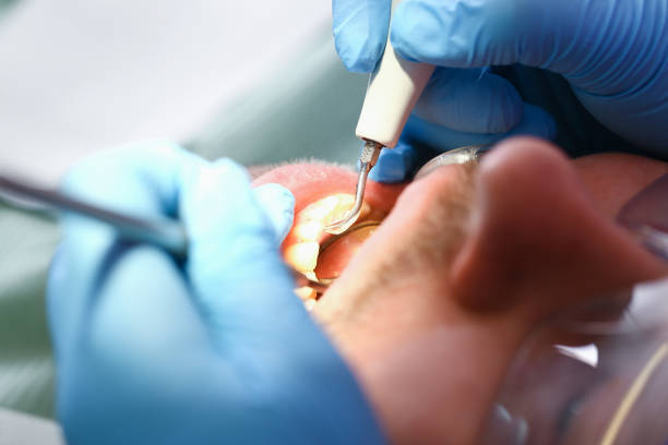 Best Emergency Dental Extractions in San Joaquin, CA